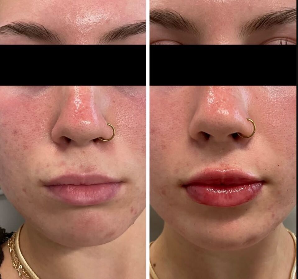 Before and after lip filler results at 816 Aesthetic Med Spa in Kansas City